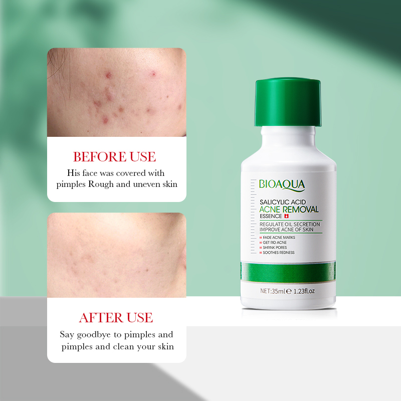 35ml BIOAOUA Acido Salicilico  - Tranexamic Acid Serum recensione e prezzo